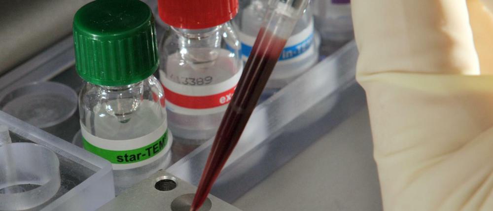 Bluttest statt unangenehmer Biopsie - bei der Krebsvorsorge noch lange nicht Alltag, aber auch keine Utopie mehr. (Symbolbild)
