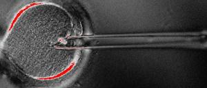 Heikel. Mit einer Pipette wird vorsichtig der Zellkern mit dem Erbgut der Mutter aus dem unbefruchteten Ei entfernt. Dabei können auch einige kranke Mitochondrien angesaugt werden.