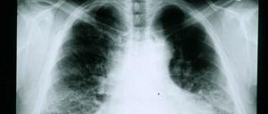 Röntgenaufnahme der Lunge eines Patienten mit Fibrose, eines übermäßigen Wachstums von Bindegewebszellen. 