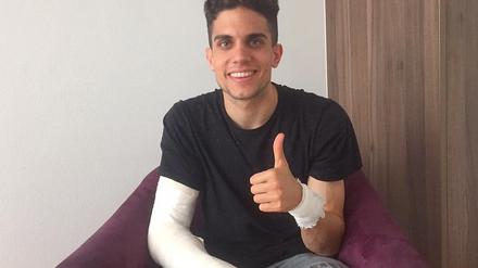 Marc Bartra hatte sich bei dem Sprengstoffanschlag auf den Mannschaftsbus von Borussia Dortmund eine gebrochene Speiche im rechten Handgelenk zugezogen.