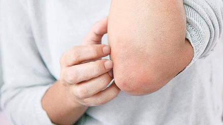 Quälender Juckreiz. Neurodermitis betrifft vor allem Kinder. Doch manchmal haben auch Erwachsene noch mit dem Hautleiden zu tun.