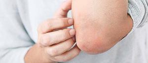 Quälender Juckreiz. Neurodermitis betrifft vor allem Kinder. Doch manchmal haben auch Erwachsene noch mit dem Hautleiden zu tun.