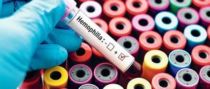 Erhoffte Heilung. Bluterkranke könnten vom ständigen Spritzen von Gerinnungsfaktoren befreit werden. Fraglich ist nur, wie lange die neue Gentherapie wirkt.