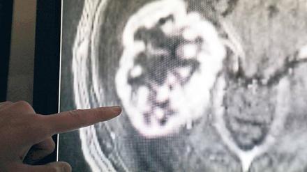 Fataler Fingerzeig. Die Idee ist gut: Krebs so früh wie möglich entdecken, um erfolgreich behandeln zu können. Doch damit gehen viele Fälle einher, die unnötige, langwierige, teure und psychisch belastende Diagnostik über sich ergehen lassen müssen. 