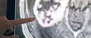 Fataler Fingerzeig. Die Idee ist gut: Krebs so früh wie möglich entdecken, um erfolgreich behandeln zu können. Doch damit gehen viele Fälle einher, die unnötige, langwierige, teure und psychisch belastende Diagnostik über sich ergehen lassen müssen. 