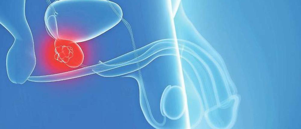 Die von Nervenbahnen durchzogene Prostata liegt unter der Harnblase. Wenn die Drüse von Krebs befallen ist und anschwillt, erhöht sich der Gehalt an PSA-Protein im Blut.
