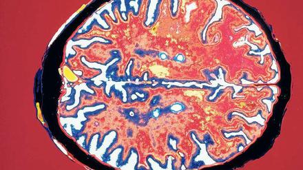 Blick in das Gehirn eines MS-Patienten. Gelb markiert sind Krankheitsherde. 