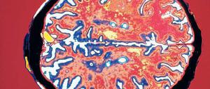 Blick in das Gehirn eines MS-Patienten. Gelb markiert sind Krankheitsherde.