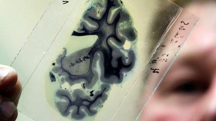 Bei der Alzheimer Erkrankung sterben langsam aber unaufhaltsam die Nervenzellen ab, die das Gedächtnis ausmachen. 