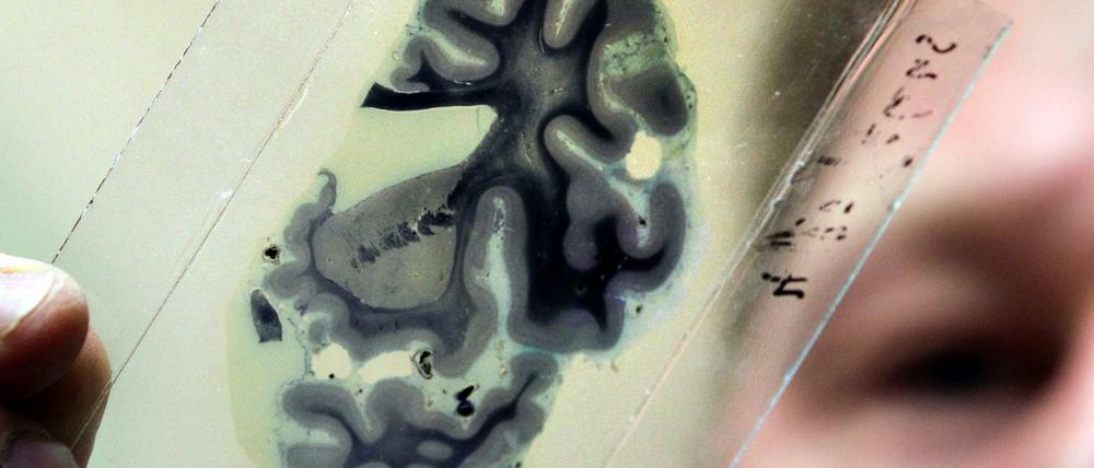 Bei der Alzheimer Erkrankung sterben langsam aber unaufhaltsam die Nervenzellen ab, die das Gedächtnis ausmachen.