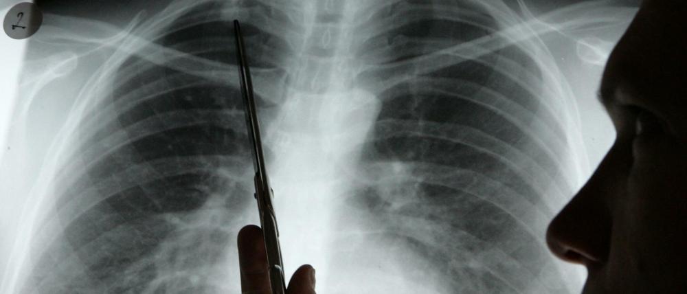 Diagnose Lungenkrebs. EU-Abgeordnete wollen mehr Geld für Forschung.
