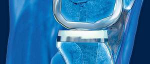 Kniefall. Nicht jedes künstliche Kniegelenk scheint nötig zu sein.