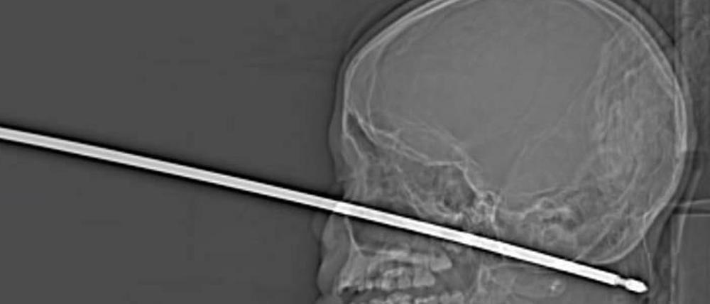 Röntgenbild des 10-jährigen Jungen mit Metallspieß im Kopf.