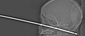 Röntgenbild des 10-jährigen Jungen mit Metallspieß im Kopf.