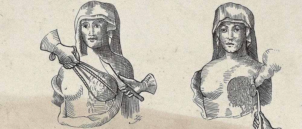 Diese Zeichnung aus dem Jahre 1603 zeigt eine Brustentfernung und die anschließende Kauterisierung der Wunde mit glühendem Metall.
