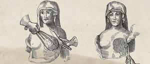 Diese Zeichnung aus dem Jahre 1603 zeigt eine Brustentfernung und die anschließende Kauterisierung der Wunde mit glühendem Metall.