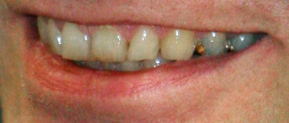 Die Mundpartie des als "Kannibale von Rotenburg" bekannt gewordenen Armin M., fotografiert vor Gericht im Jahr 2006.