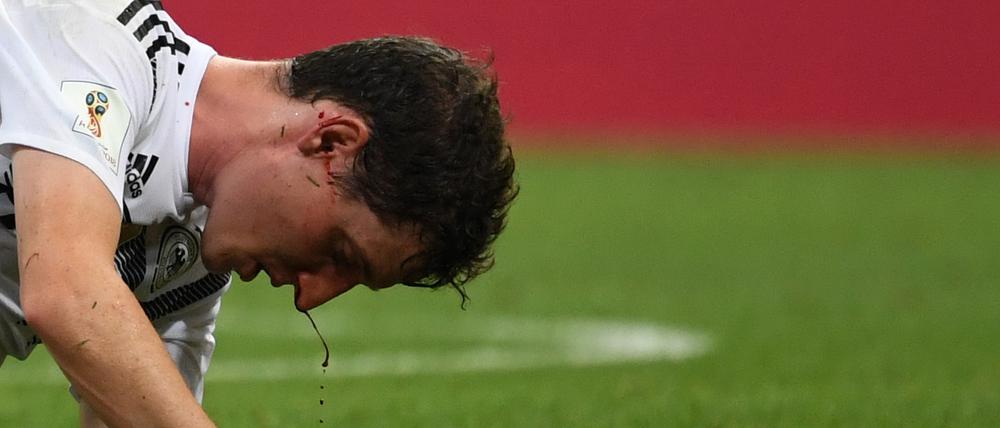 Schmerzhaft. Nicht nur Nationalspieler Sebastian Rudy weiß, wie empfindlich die Nase ist.