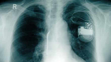 Defekte Implantate können lebensgefährlich sein. Hier ein Herzschrittmacher auf dem Röntgenbild.