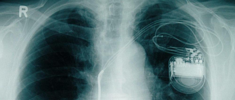 Defekte Implantate können lebensgefährlich sein. Hier ein Herzschrittmacher auf dem Röntgenbild.