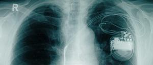 Defekte Implantate können lebensgefährlich sein. Hier ein Herzschrittmacher auf dem Röntgenbild.
