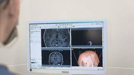 Mit Computerunterstützung verkabeln Ärzte das Gehirn von Patienten mit Parkinson und anderen Erkrankungen, um Bewegungsstörungen und weitere Symptome psychischer und neurologischer Krankheiten zu lindern. 