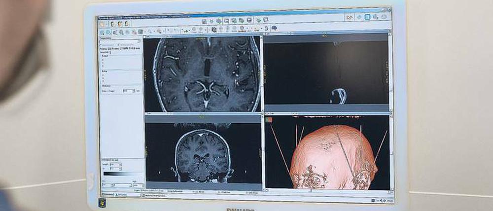 Mit Computerunterstützung verkabeln Ärzte das Gehirn von Patienten mit Parkinson und anderen Erkrankungen, um Bewegungsstörungen und weitere Symptome psychischer und neurologischer Krankheiten zu lindern. 