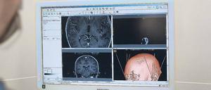Mit Computerunterstützung verkabeln Ärzte das Gehirn von Patienten mit Parkinson und anderen Erkrankungen, um Bewegungsstörungen und weitere Symptome psychischer und neurologischer Krankheiten zu lindern. 