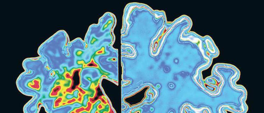 Entnervt. In Gehirnen von Alzheimer-Patienten (links) sammeln sich falsch gefaltete Amyloid-Eiweiße an (rot), dann sterben die Nervenzellen und das Gehirn schrumpft.