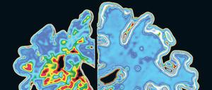 Entnervt. In Gehirnen von Alzheimer-Patienten (links) sammeln sich falsch gefaltete Amyloid-Eiweiße an (rot), dann sterben die Nervenzellen und das Gehirn schrumpft. 