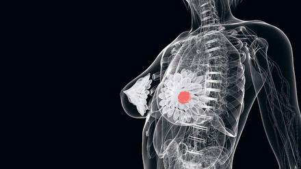 Jede zehnte Frau in Deutschland, die die Diagnose Brustkrebs bekommt, ist jünger als 45 Jahre. Bluttests, die krebstypische Moleküle nachweisen, sollen frühere Diagnosen ermöglichen, sind aber noch nicht ausgereift. 