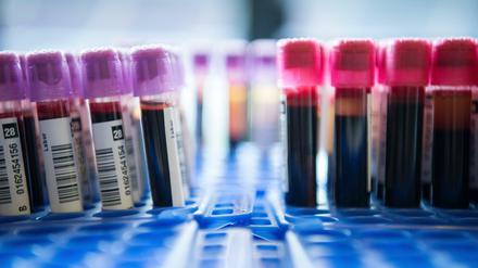 Im Blut lassen sich Hinweise auf Brustkrebs und andere Erkrankungen finden. Doch das reicht nicht immer aus für eine sichere Diagnose. 