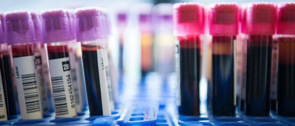 Im Blut lassen sich Hinweise auf Brustkrebs und andere Erkrankungen finden. Doch das reicht nicht immer aus für eine sichere Diagnose. 
