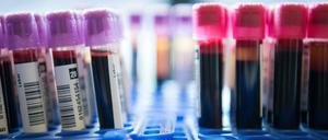 Im Blut lassen sich Hinweise auf Brustkrebs und andere Erkrankungen finden. Doch das reicht nicht immer aus für eine sichere Diagnose. 