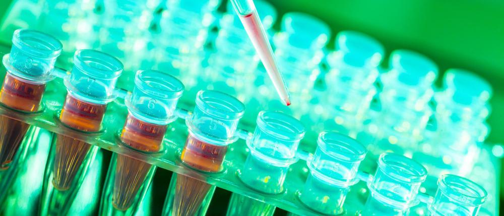 Bislang müssen Ärzte Gewebeproben nehmen, um Brustkrebs zu diagnostizieren. Ein Bluttest (Liquid Biopsy), der krebstypische Moleküle nachweist, könnte Frauen das ersparen, ist aber noch nicht ausgereift.