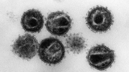 Mehrere Humane Immunschwäche-Viren (HIV) unter dem Elektronenmikroskop.