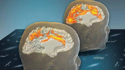 Erregung runter. Resultate einer Neurofeedback-Variante, dargestellt mit „Funktionaler Magnetresonanztomografie“. Nach einer Trainings-Session am Vortag ist in den entprechenden Hirnregionen einen Tag später weniger Nervenerregung zu sehen. 