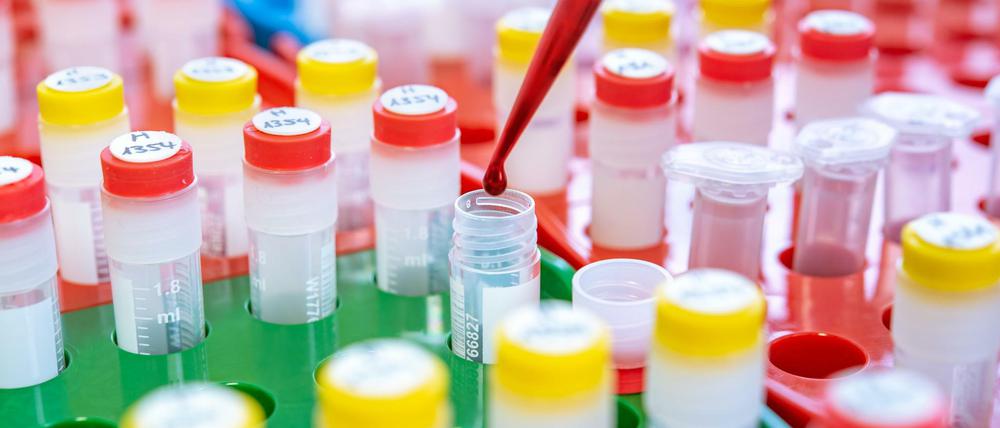 Im Blut frühe Anzeichen von Brustkrebs zu finden - das soll der "HeiScreen" testen leisten. Doch die Affäre um die verfrühte PR-Kampagne für das Verfahren hat nun erste personelle Konsequenzen.