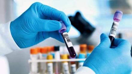 Im Blut der Probanden suchten die Forscher nach Biomarkern.