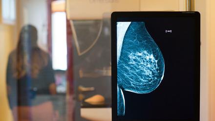 Hormonersatztherapien, die länger als ein Jahr dauern, erhöhen das Brustkrebsrisiko. 