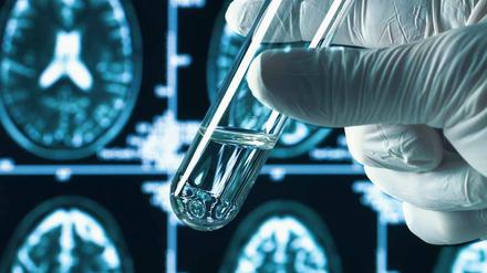 Hausaufgaben. Auf der Suche nach neuen Therapien müssen Alzheimerforscher jetzt zurück ins Labor.