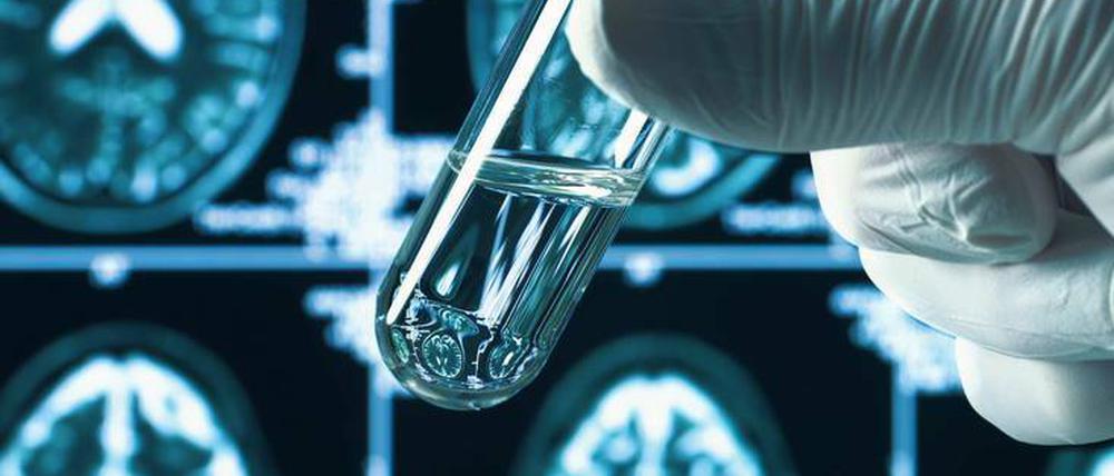 Hausaufgaben. Auf der Suche nach neuen Therapien müssen Alzheimerforscher jetzt zurück ins Labor. 