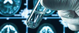 Hausaufgaben. Auf der Suche nach neuen Therapien müssen Alzheimerforscher jetzt zurück ins Labor. 