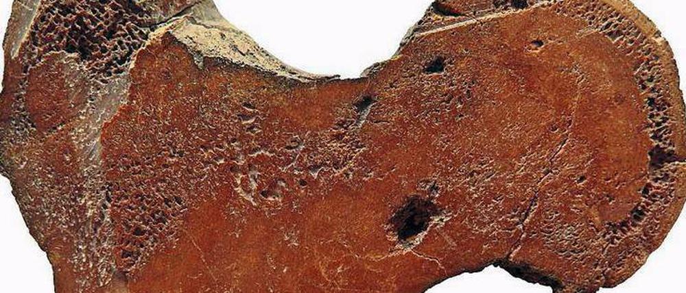 Brüchig. Ein Übermaß an Knochenmasse erhöht die Stabilität nicht etwa, sondern bei Menschen mit "Marmorknochen"-Krankheit steigt das Risiko für Brüche.