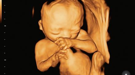 Mit einem 3-D-Ultraschall lassen sich eventuelle Fehlbildungen des Ungeborenen erkennen, die nicht immer eine vermeidbare Ursache haben, sondern mitunter einfach „zufällig“ passieren. 