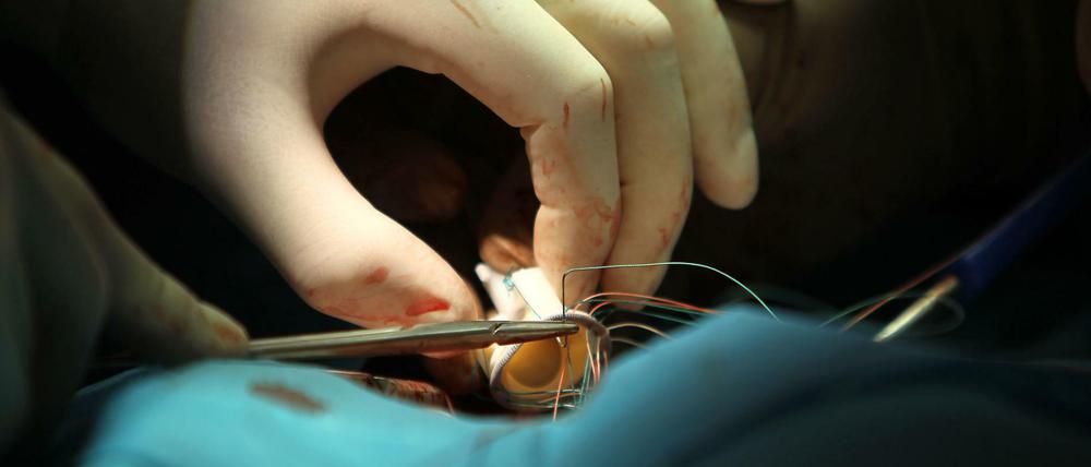 Ein Chirurg bereitetin einem Operationssaal einen Herzklappenersatz für einen Patienten vor.