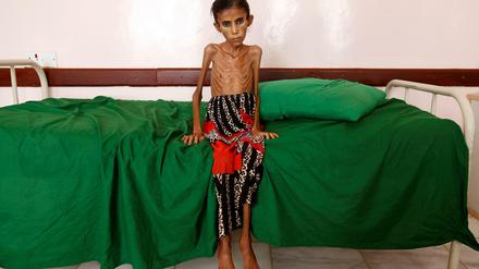 Abgemagert bis auf die Knochen. Fatima ist zwölf Jahre alt – und wiegt gerade einmal zehn Kilogramm. Millionen Kinder im Jemen hungern.