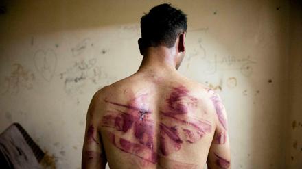 Dieser Syrer wurde von Regimekräften schwer gefoltert, das Foto wurde im August 2012 in Aleppo gemacht. 