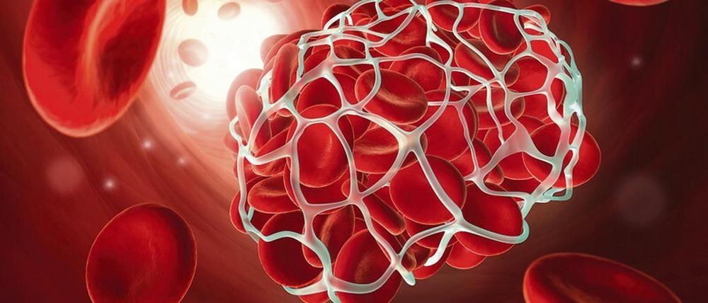 Koagulation. Wenn Blutzellen sich zusammentun – koagulieren –, kann das vorteilhaft sein, etwa, wenn eine Wunde geschlossen wird. Verschließt ein solcher Pfropfen dagegen ein Gefäß, drohen ernste gesundheitliche Folgen. Foto: mauritius images/peterschreiber.media/Alamy