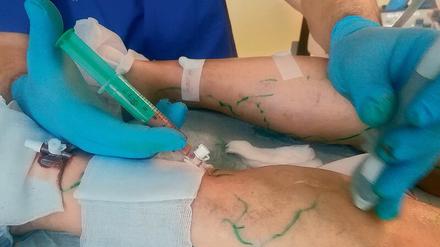 Bei der Behandlung. Der Berliner Venenarzt Johann Ragg setzt verschiedene Mikrotechniken ein. Mit einer Kombination aus Laser – und Verödungstechnik will er die Venenprobleme seiner Patienten in den Griff bekommen. 